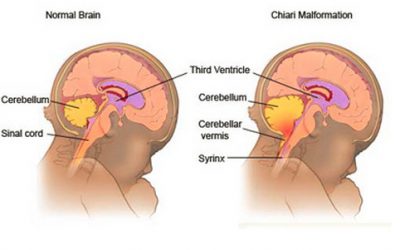 سندرم Arnold chiari چیست ؟