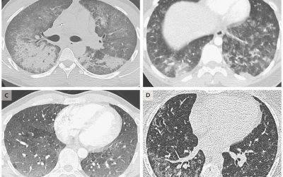 ضرورت استفاده از معیارهای رادیولوژیکی در تفسیر تصاویر سی تی اسکن ریه بیماران مشکوک به کرونا ویروس