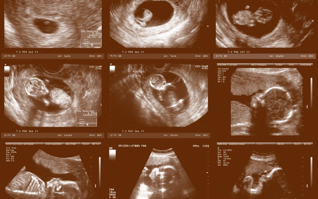 0 تا 100 سونوگرافی غربالگری دوم ، هر چیزی که برای تشخیص ناهنجاری جنین با سونوگرافی باید بدانید