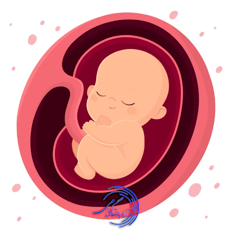 بررسی انواع جفت در زمان بارداری | دکتر رضا گرامی