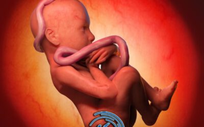 پیچیدن بند ناف دور گردن جنین  | علت گره خوردن بند ناف دور گردن جنین